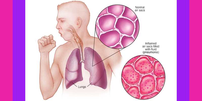 Homoeopathic Management of Pneumonia In a Child of Two Years