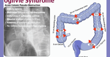 Iatrogenic Ogilvie Syndrom