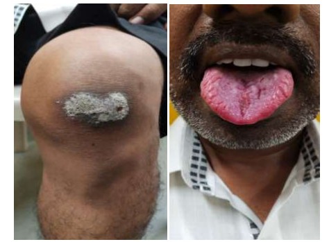 Homoeopathic management of a case of psoriasis