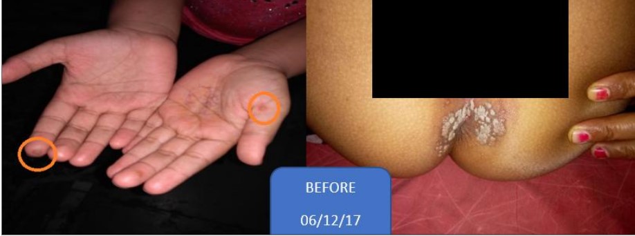 Clinical study demonstrating the role of effective homeopathic management in sycotic manifestation- WARTS