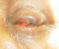 Traumatic Suppurative Eye – Threat to Vision